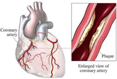 plaque in the coronary artery