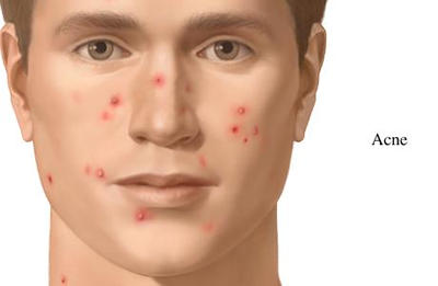 Acne Acne
