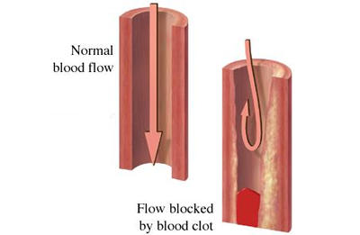 Blood clot blocking flow of blood