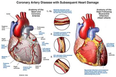 Coronary artery disease; heart damage