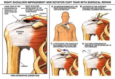 Shoulder impingement