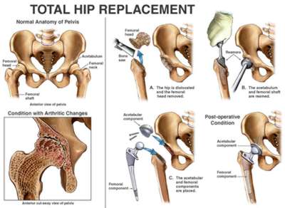 Total hip replacement