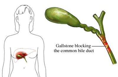 Gallstone blocking the duct of the gallbladder Gallstone blocking the bile duct