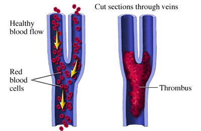 Deep vein thrombosis