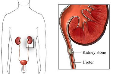 Kidney Stone; Stone in the ureter Stone in the ureter